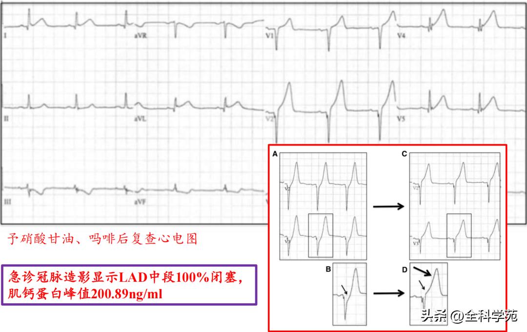t波高尖心电图判断标准,t波高尖判断标准