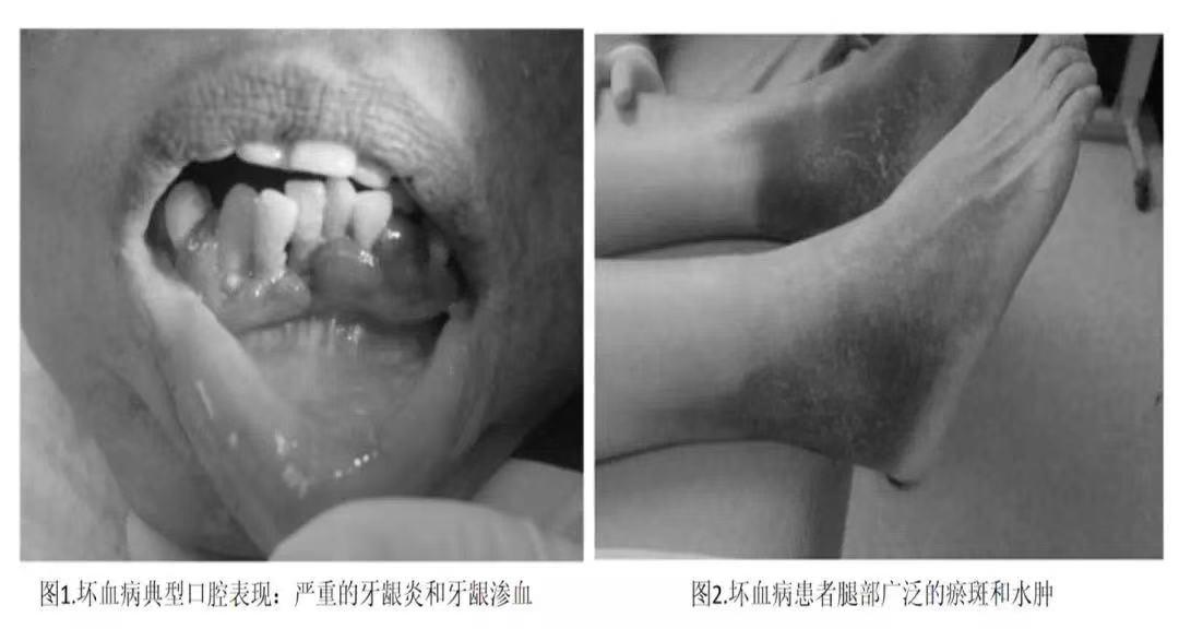 科学家发现维生素c的过程,人类用了几百年才发现维生素c