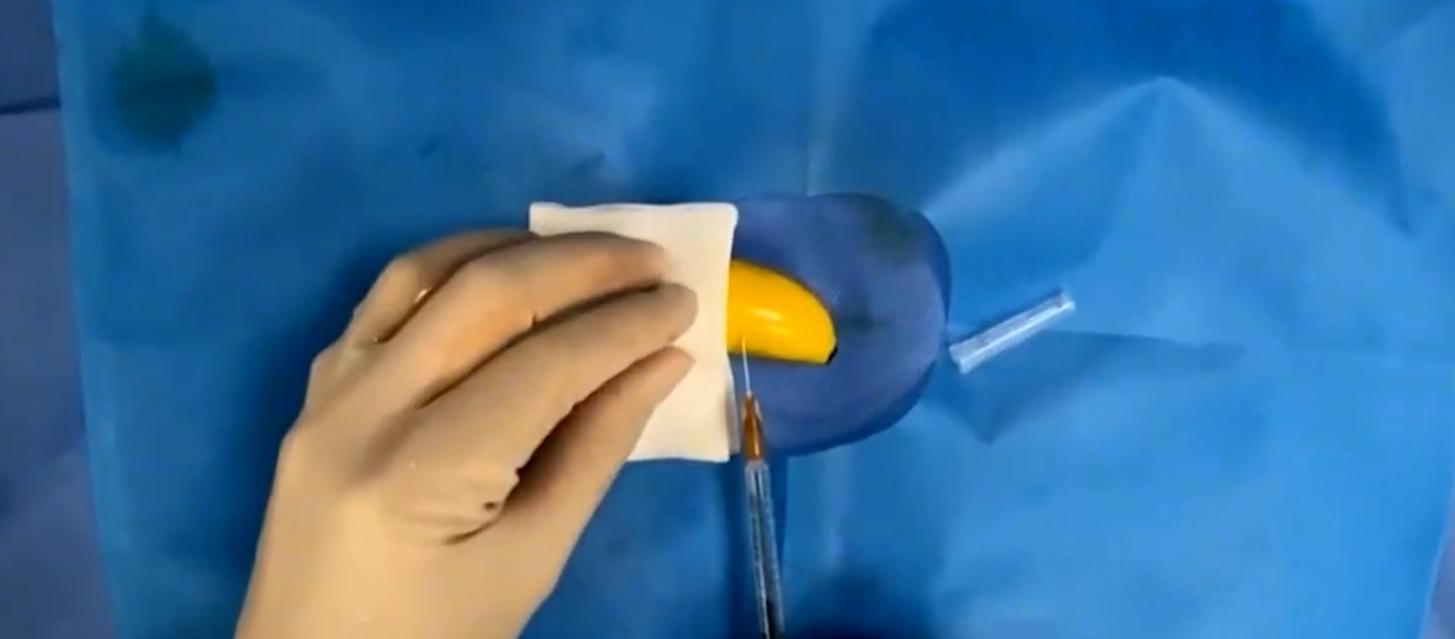 20岁小伙包皮手术死亡,割包皮死亡儿童案件后续