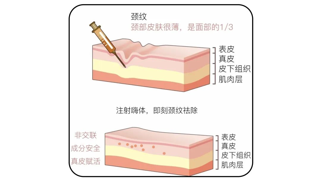 1条颈纹=显老10岁，可怕的颈纹还有救吗？