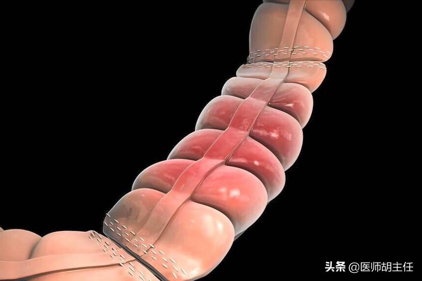 如果肠道长息肉身体会有哪些反应,肠道长息肉会有什么症状