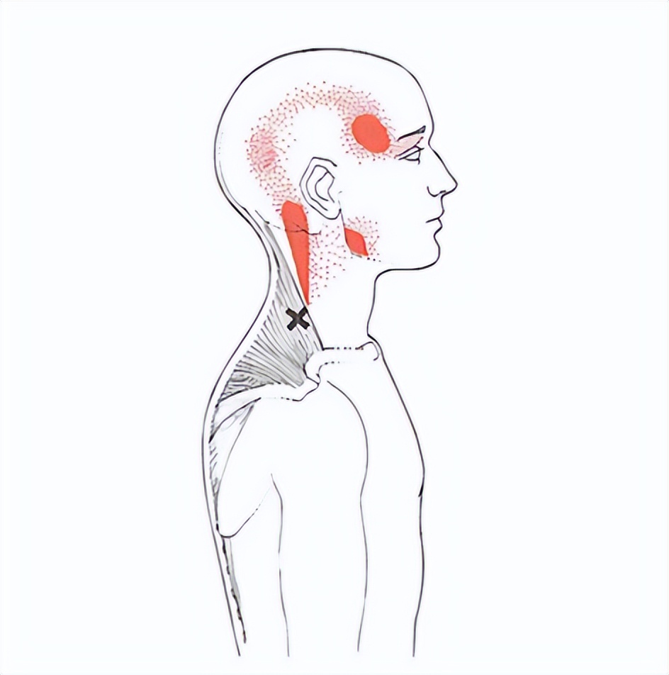 肩颈疼痛落枕一招搞定,落枕脖子疼高低肩最快的缓解方法