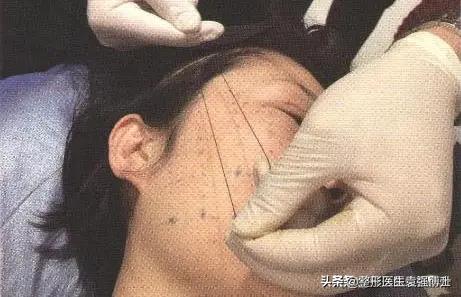 40岁松弛怎么恢复,40岁松弛下垂怎么恢复