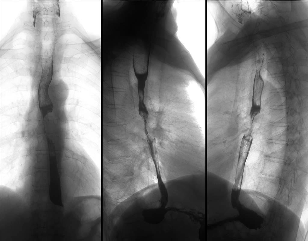 40岁左右的男子突然咳嗽,咳白色泡沫痰五六年反复是肺癌吗