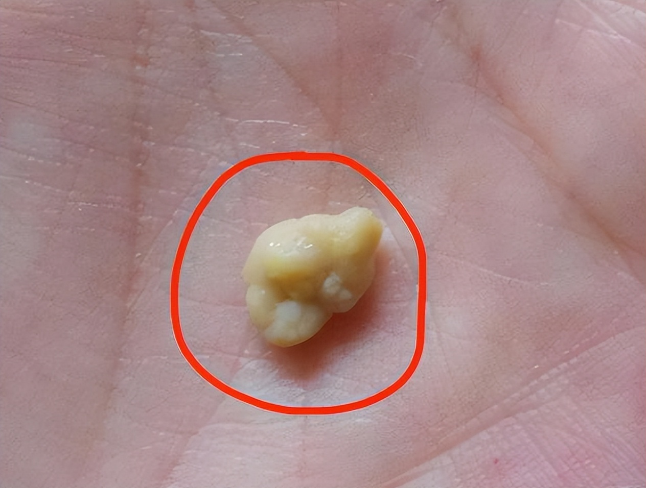 喉咙有异物感咳一下喉咙容易出血,喉咙有异物咳出水老是想咳