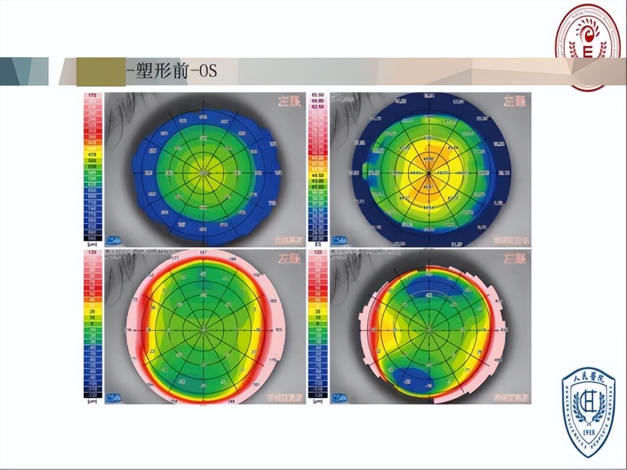 王凯角膜塑形镜原理,王凯医生塑形镜