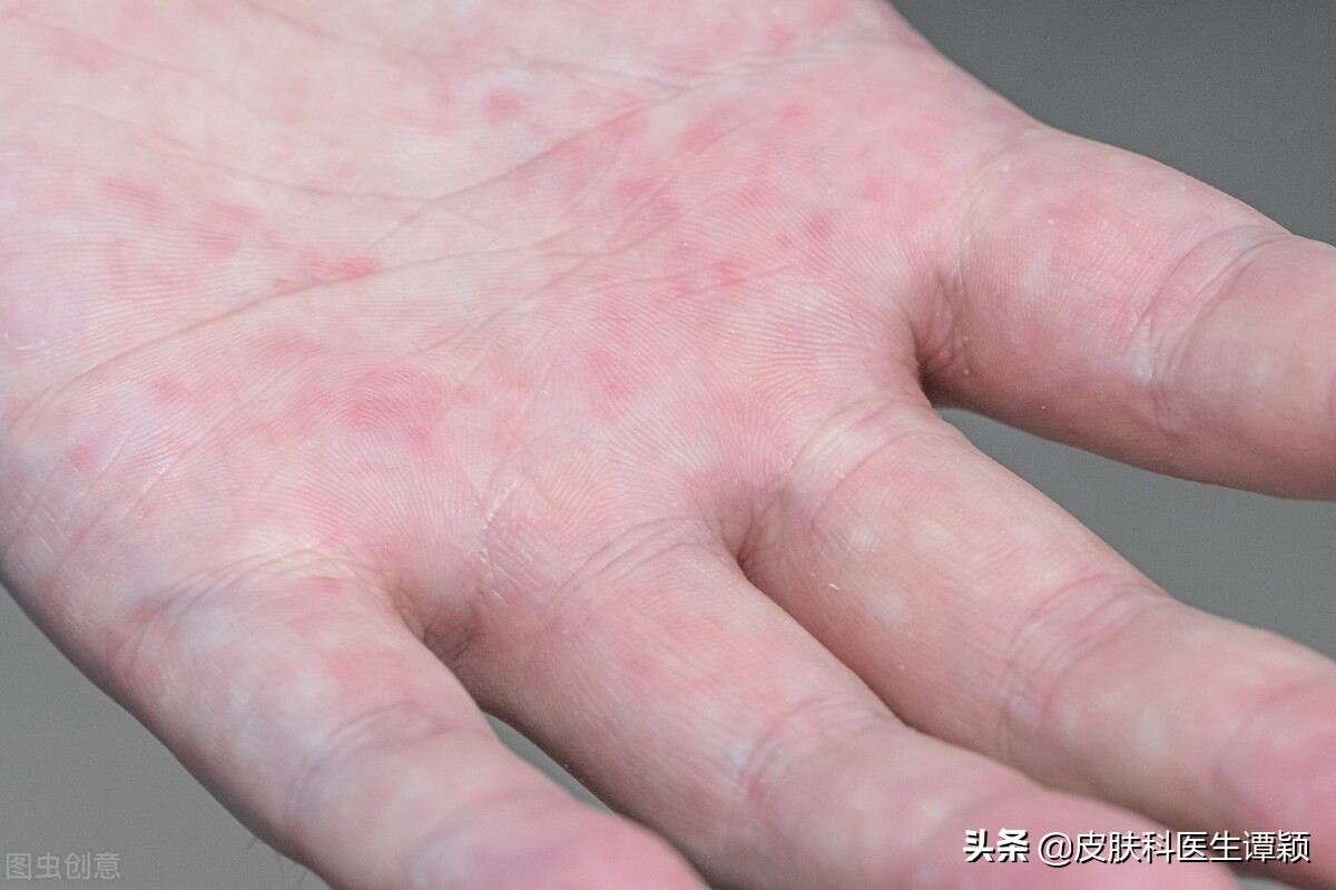 皮肤科汗疱疹真菌感染,皮肤科有关汗疱疹治疗