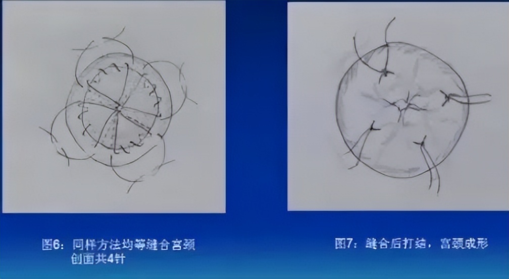 宫颈锥切手术的操作能力和技巧