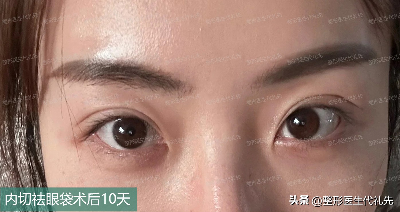 内切眼袋后1-5天恢复图,内切眼袋恢复后对比图片