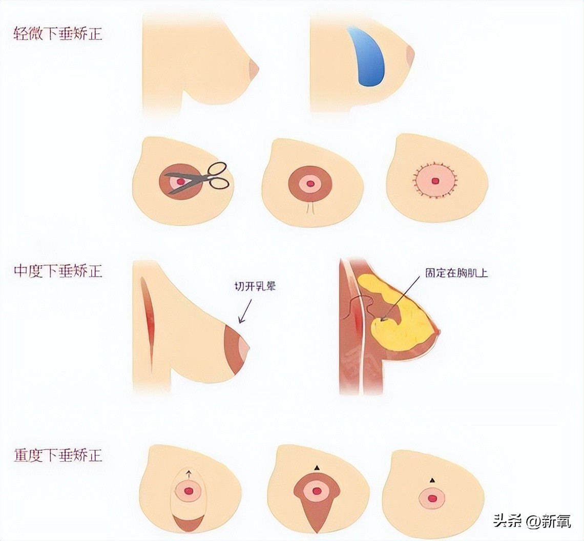胸部略微下垂,胸部有时变大有时变小怎么回事
