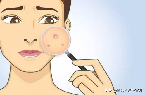 蕾特恩淡化痘印是什么产品,蕾特恩祛痘后痘印怎么越来越多了