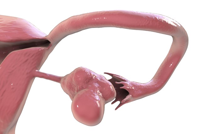 输卵管积水引起不孕怎么治疗,输卵管不孕的诊断和治疗