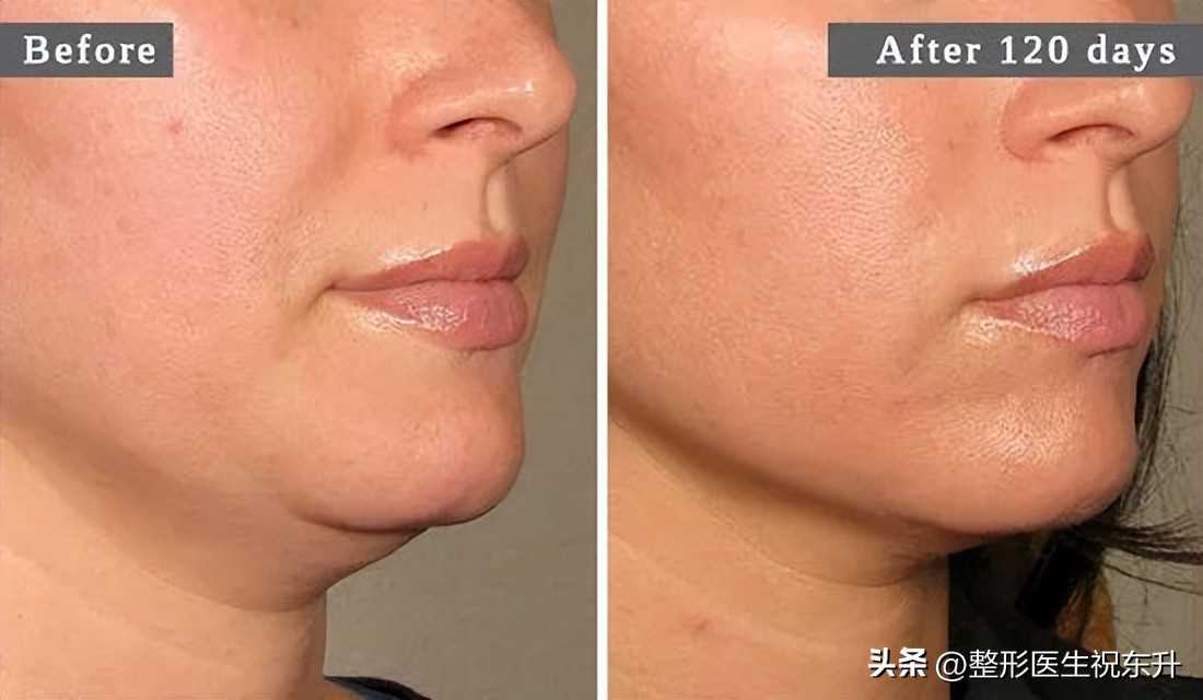面部年轻化项目,面部年轻化案例