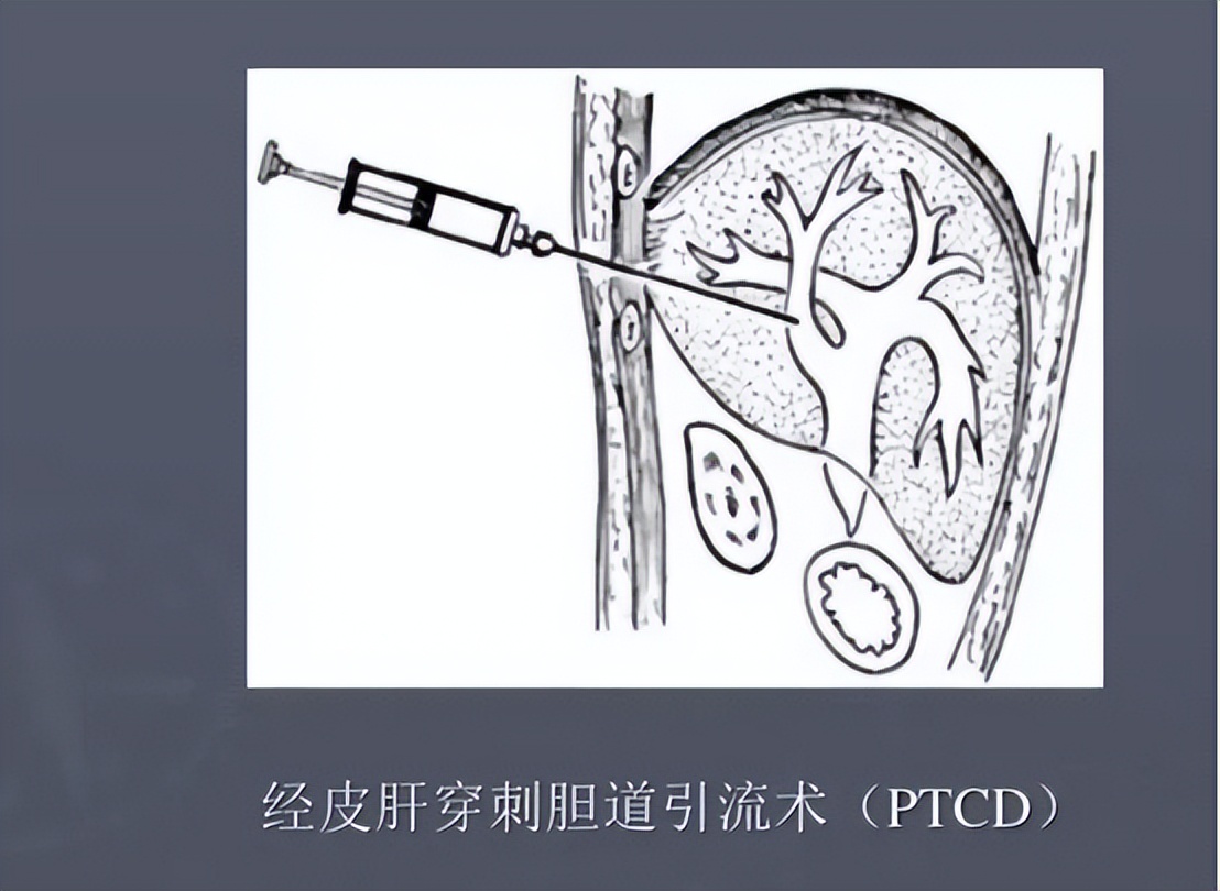 急性胆囊炎的主要治疗方法有哪些,急性胆囊炎最佳的治疗方案是什么