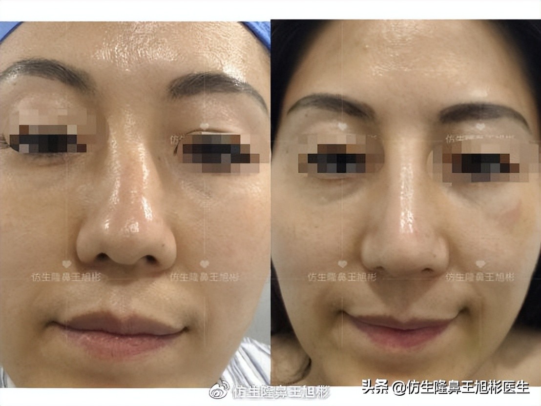 歪鼻可以用什么方法矫正,歪鼻矫正的危害