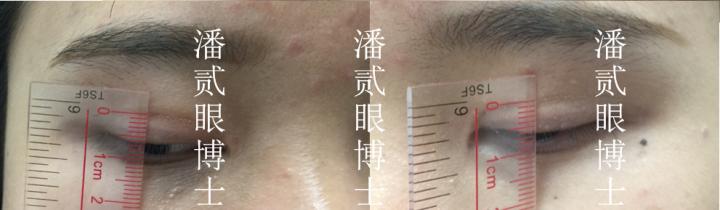 上海宽改窄双眼皮修复案例对比,宽变窄双眼皮修复过程对比