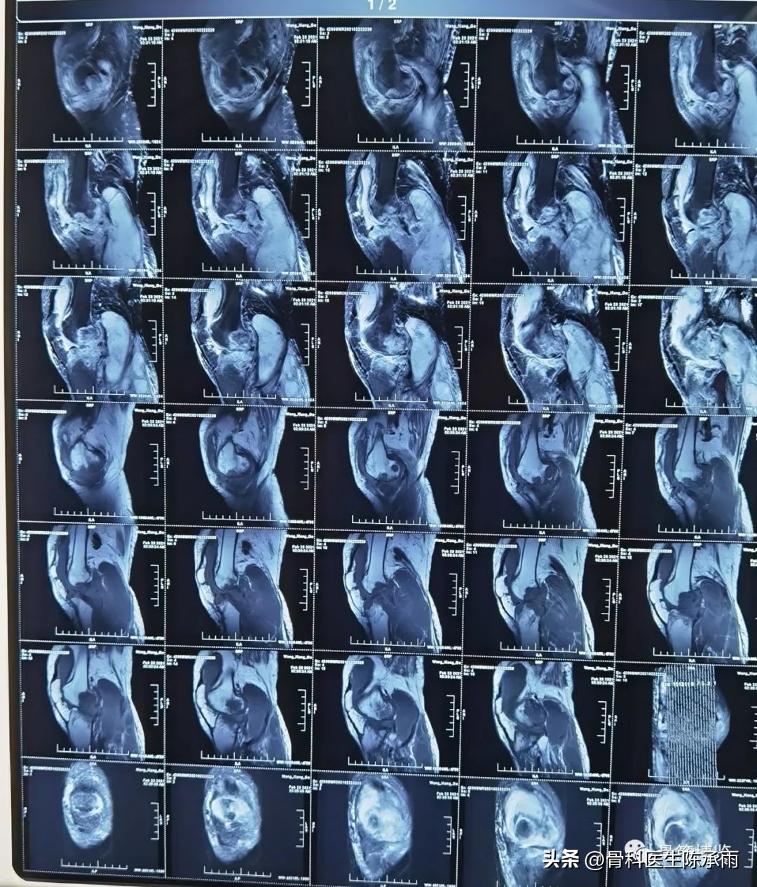 化脓性关节炎的穿刺引流治疗,关节炎镜下治疗