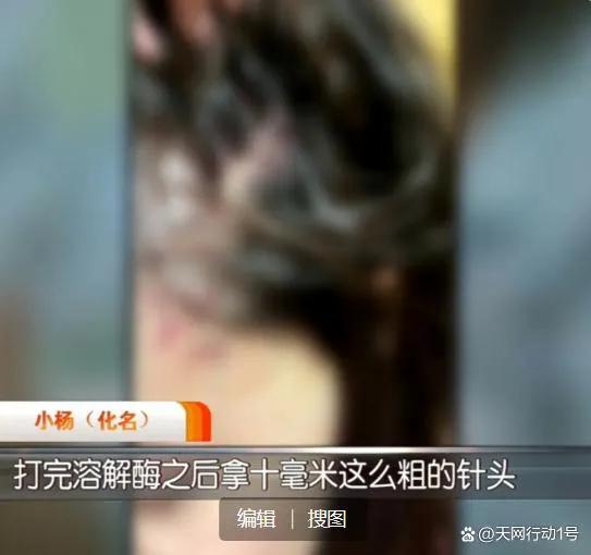 空姐注射玻尿酸出血进医院,空姐注射玻尿酸太阳穴栓塞