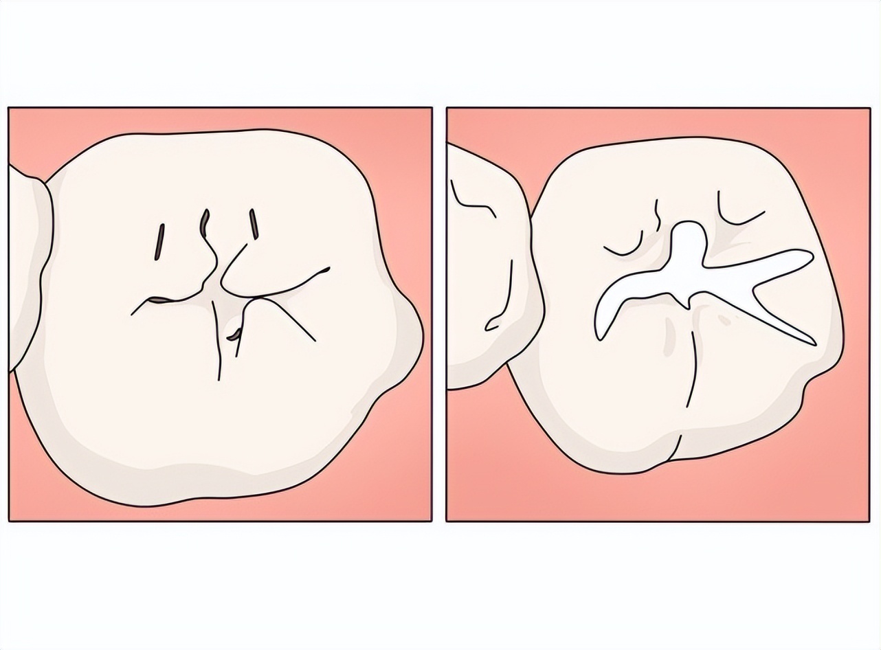 儿童满口蛀牙该怎么护理牙齿,上海孩子有蛀牙牙疼怎么办