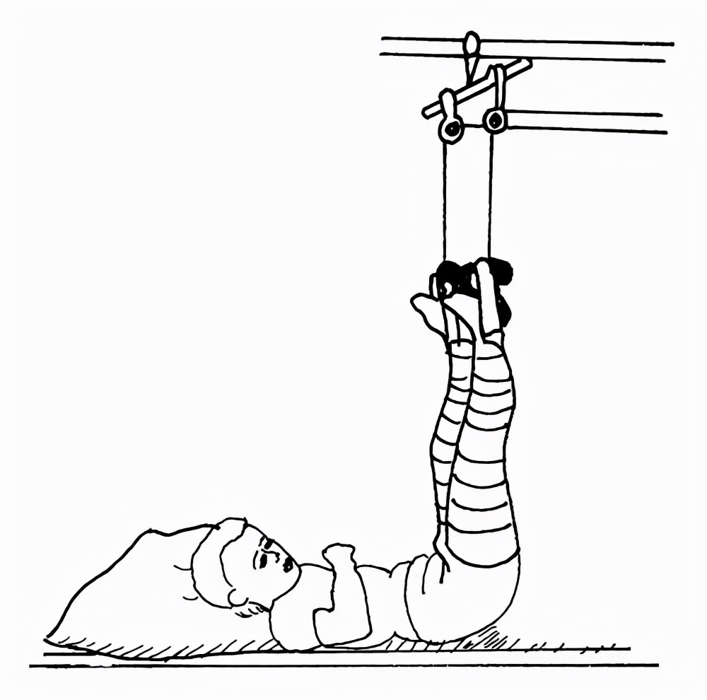 儿童股骨骨折手术全过程,小孩股骨骨折保守治疗还是手术