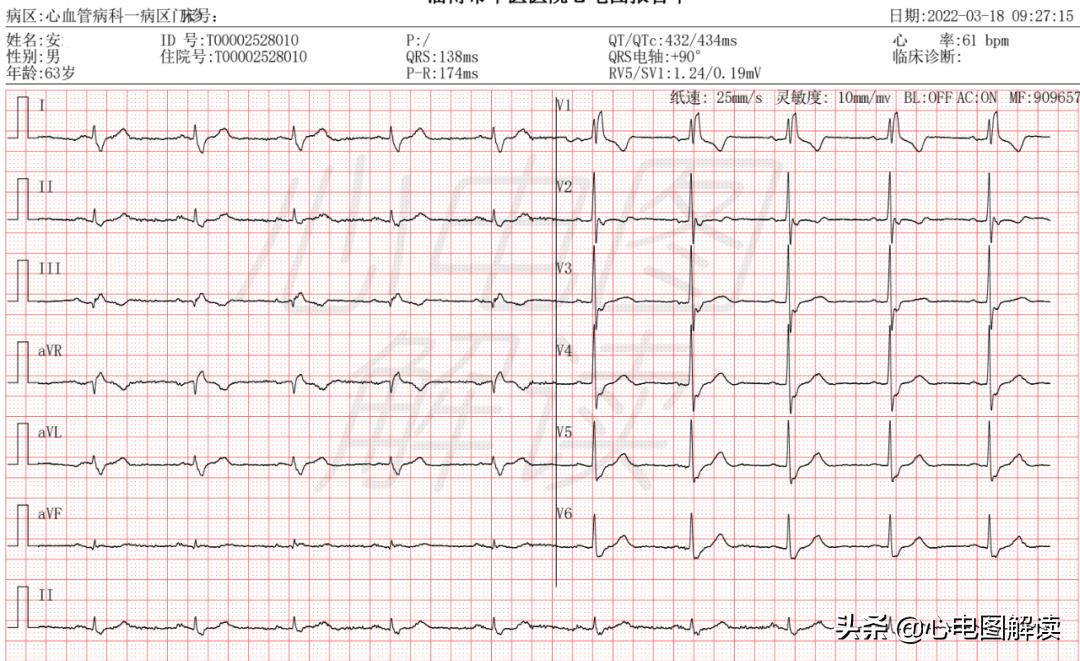 右束支阻滞训练方法,右束支阻滞自愈