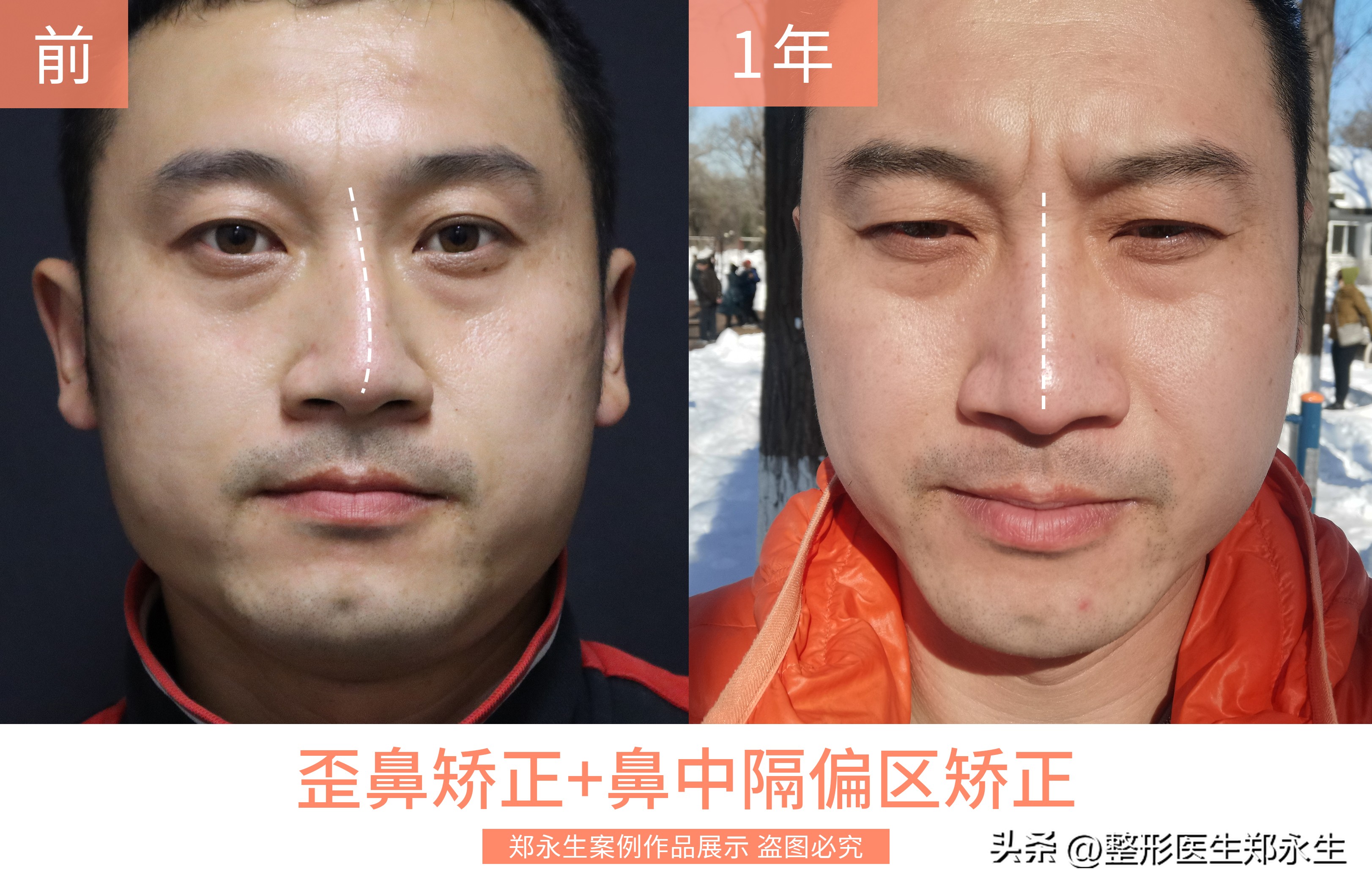 鼻中隔偏曲可以通过正骨矫正吗,鼻中隔偏曲矫正手术全过程真人