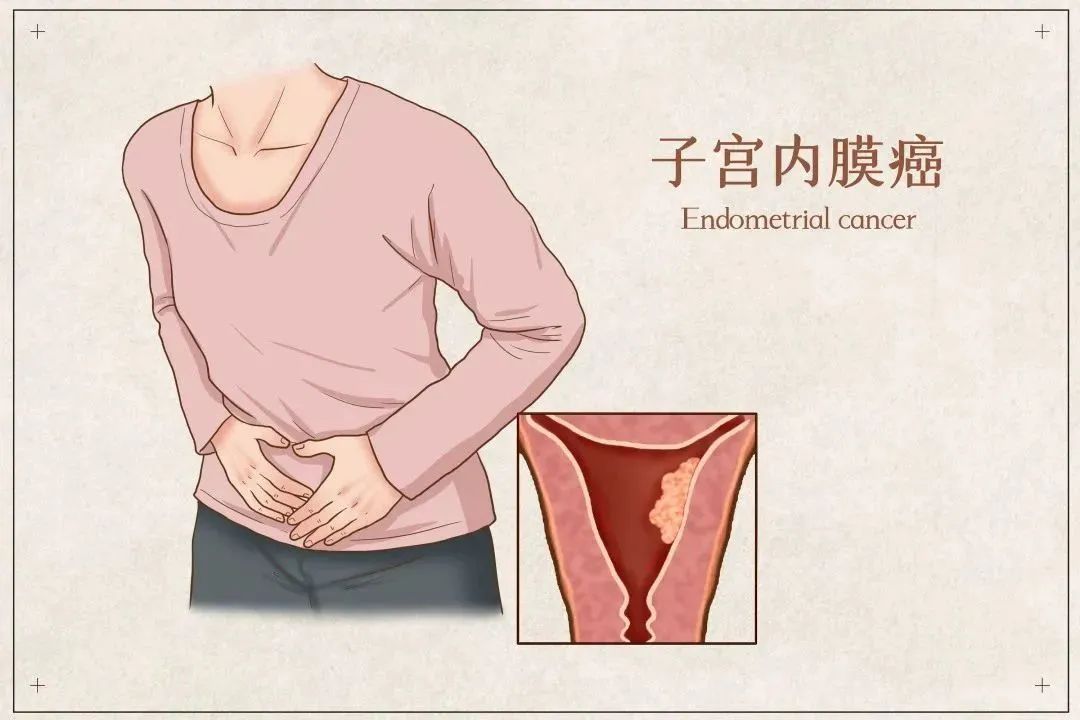 绝经后又来月经是真的有病了吗,绝经之后又来大姨妈是什么问题