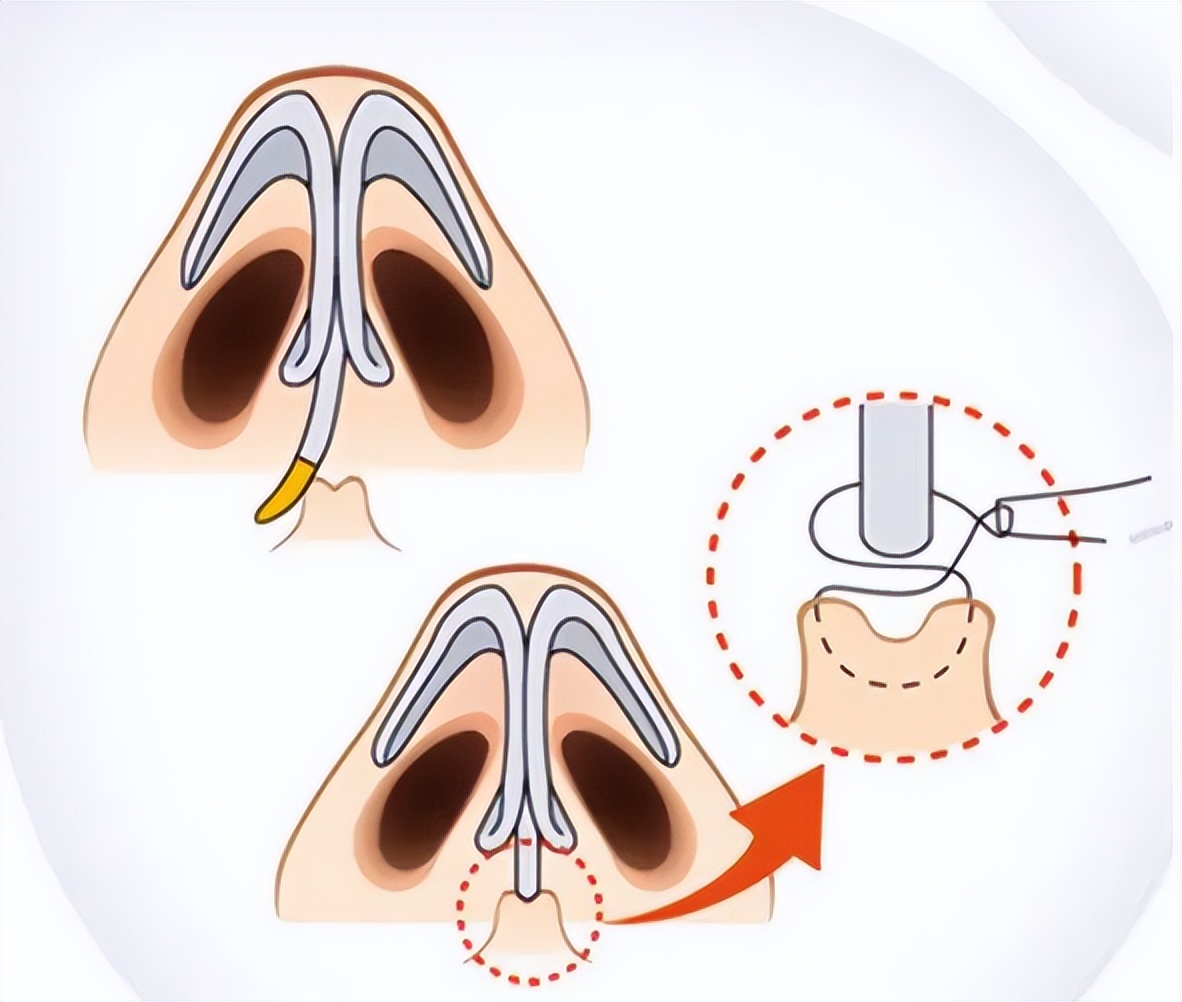 没感冒鼻子不通气是什么原因,鼻子不通气冒火什么原因引起