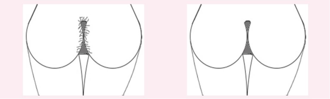 *处私**的毛发为什么是卷的？可以刮掉吗？答案在这里，看看不吃亏