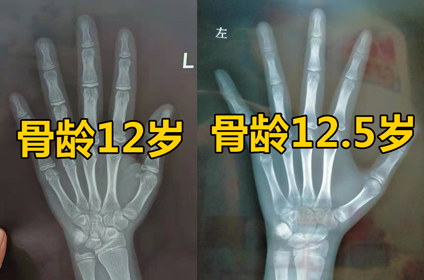 青春期15岁后做什么运动能长更高,青春期猛涨期女孩一年长多少