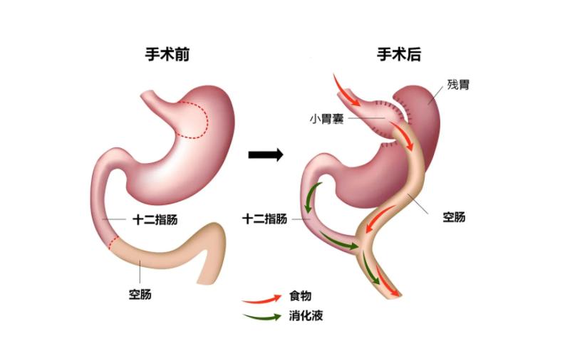 糖尿病需要手术治疗的是什么病,糖尿病可以通过手术完全治疗好吗