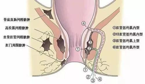 痔疮的诊疗（诊断/实用总结一）