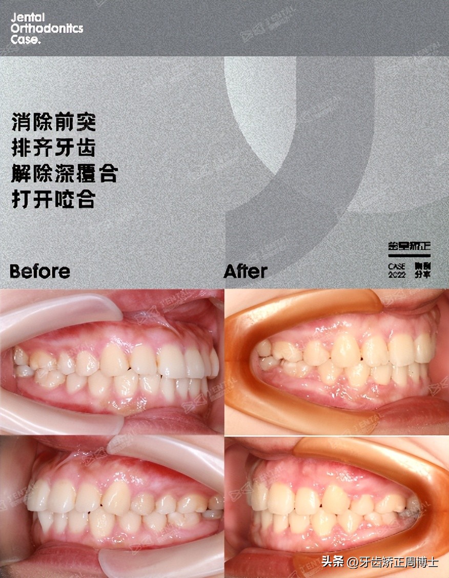 低角面型下巴前倾正畸案例,露龈笑嘴凸下巴后缩