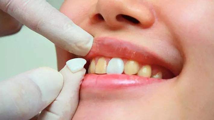 年龄大了牙齿发黄发黑,小孩牙齿发黄发黑如何清理