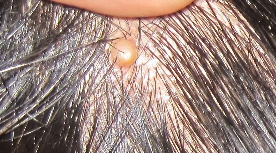 头皮上经常有疙瘩和脓包怎么回事,头皮长疙瘩脓包是什么原因