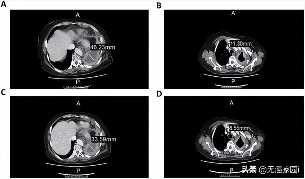 肝癌nk细胞免疫治疗,nk细胞治疗肿瘤最好的专家