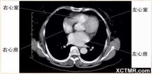 胸腹部盆腔ct主要检查什么,女性盆腔ct断层解剖结构图