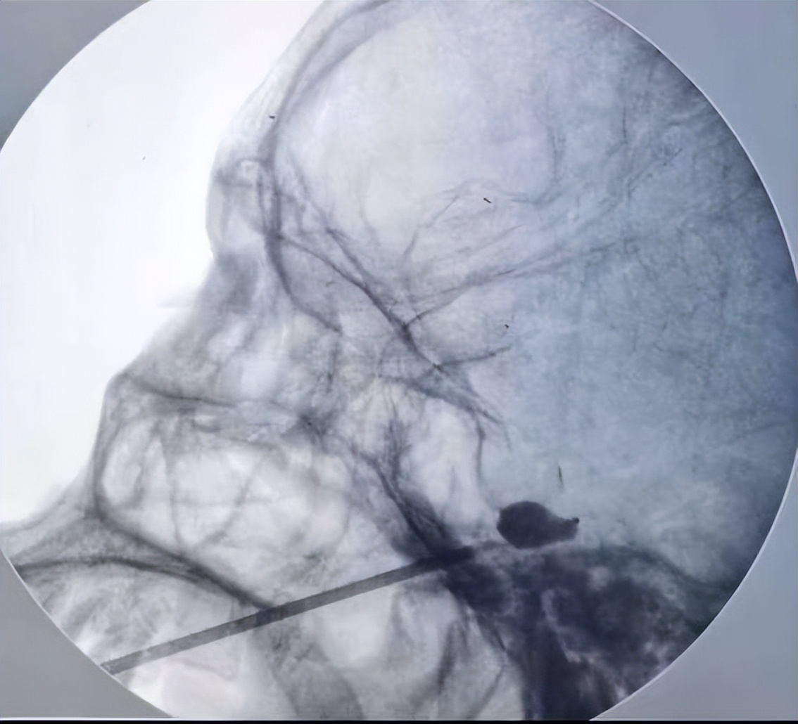 疼痛难忍最好的治疗方法,疼痛难忍的治疗