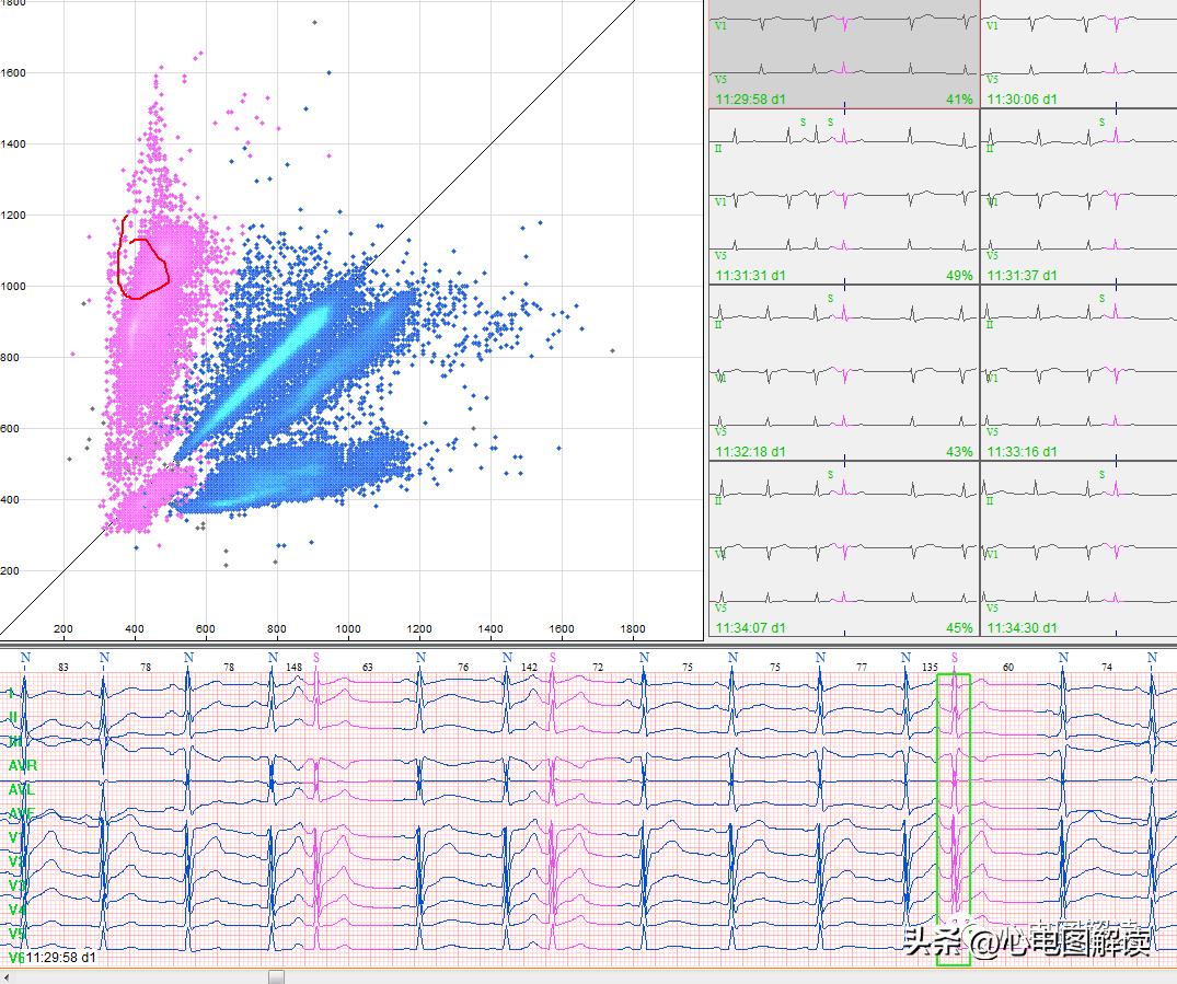 房早室早区别,房早室早房颤