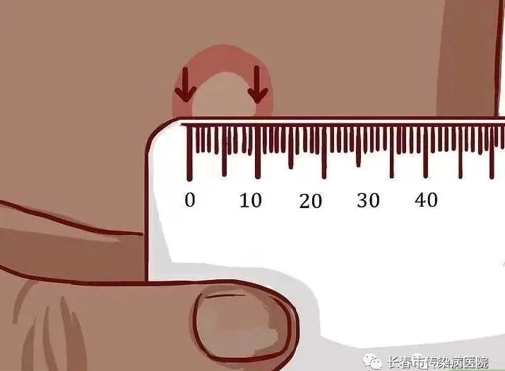 ppd试验结果为阳性是有结核病吗,ppd试验结果呈阳性是患有结核病吗