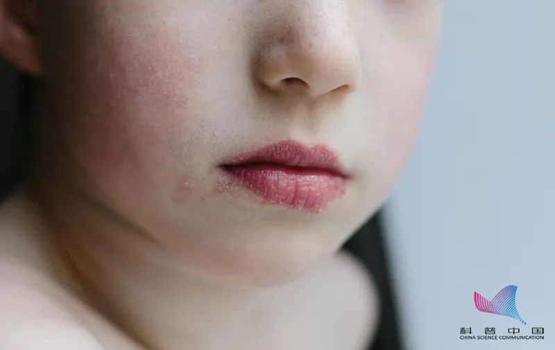 烂嘴角子是什么病,烂嘴角是什么病用什么药