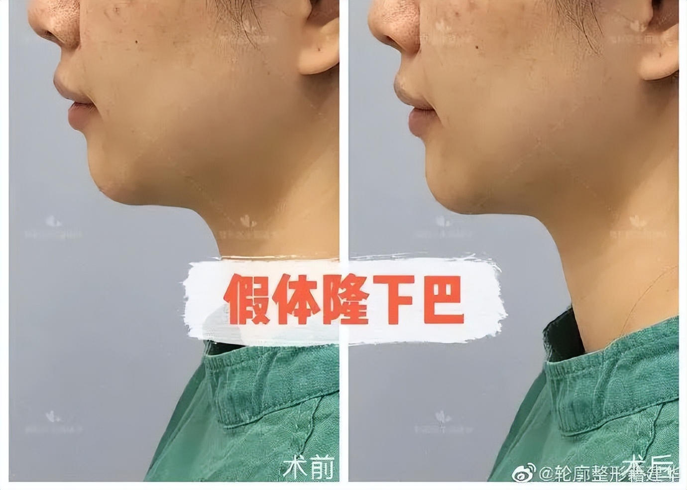 下巴后缩是不是最难看的,下巴后缩明星怎么改善