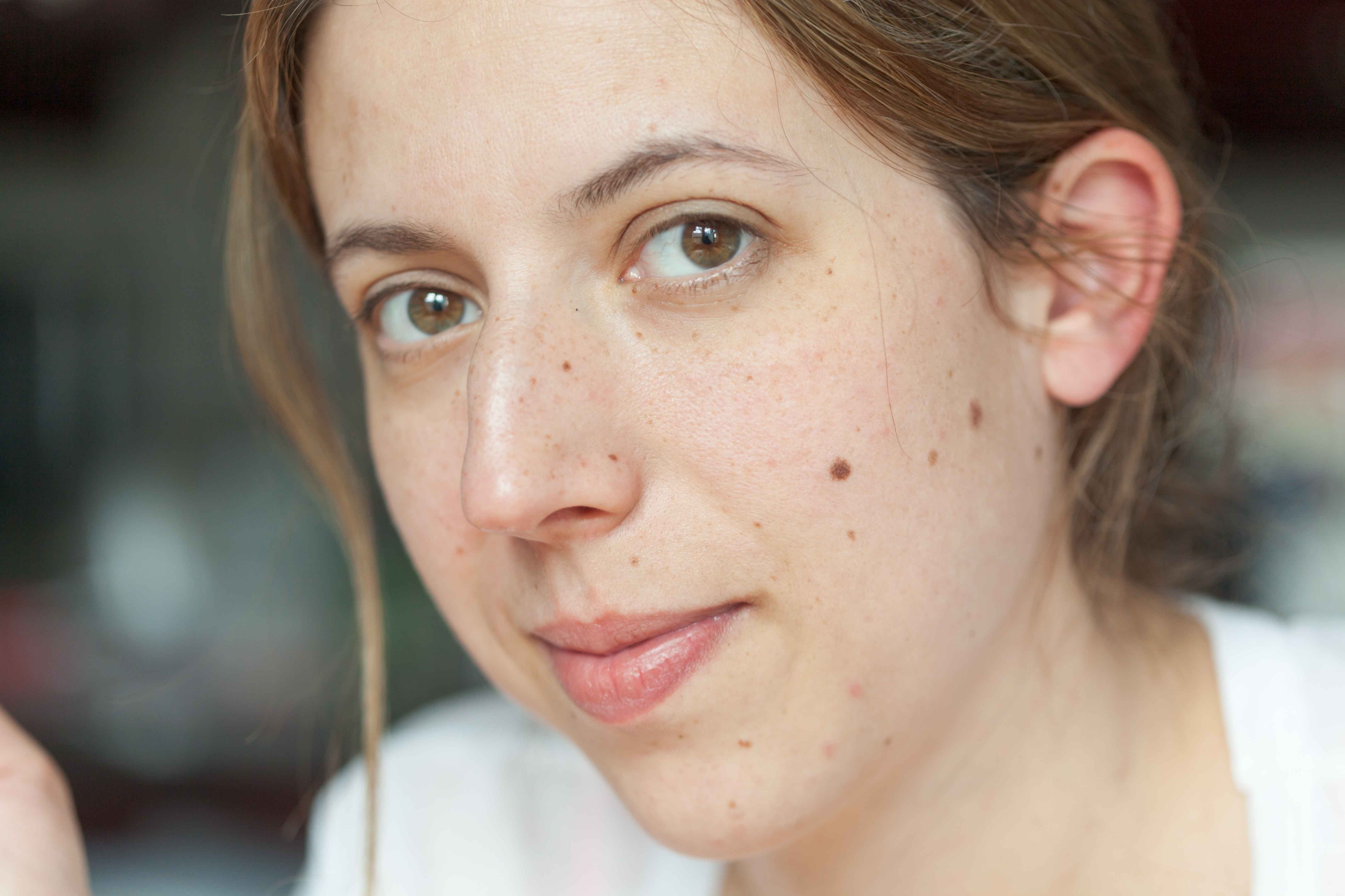 痣点了之后还会复发吗,长了10多年的痣点掉会复发吗