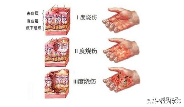 烧伤烫伤防护与急救知识英文,烧伤冻伤如何处理