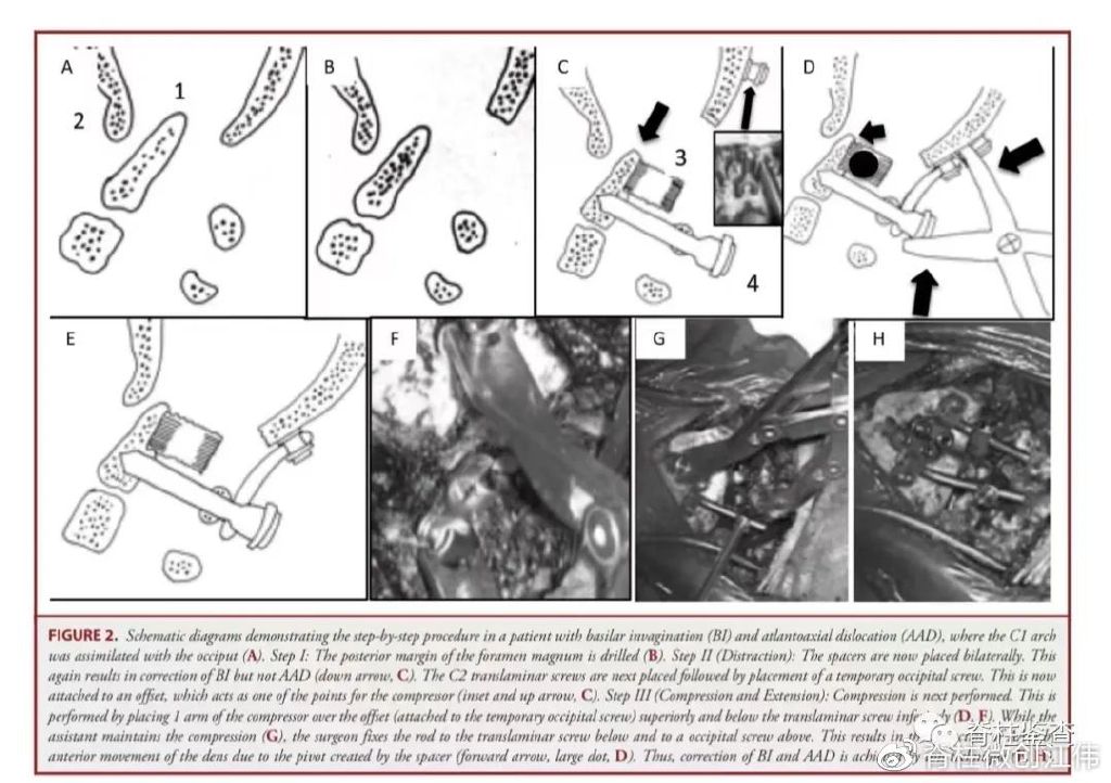 颅底凹陷症齿状突半脱位,颅底手术新突破