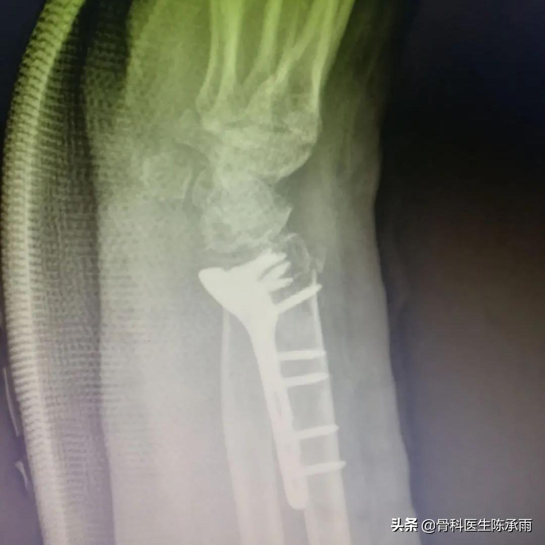 桡骨远端骨折累及关节面保守治疗,桡骨骨折保守还是手术