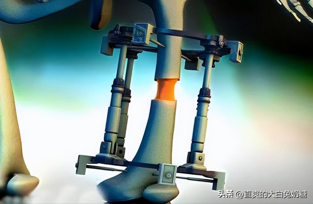 李亚诺断骨增高怎样了,断骨增高手术的李亚诺现状