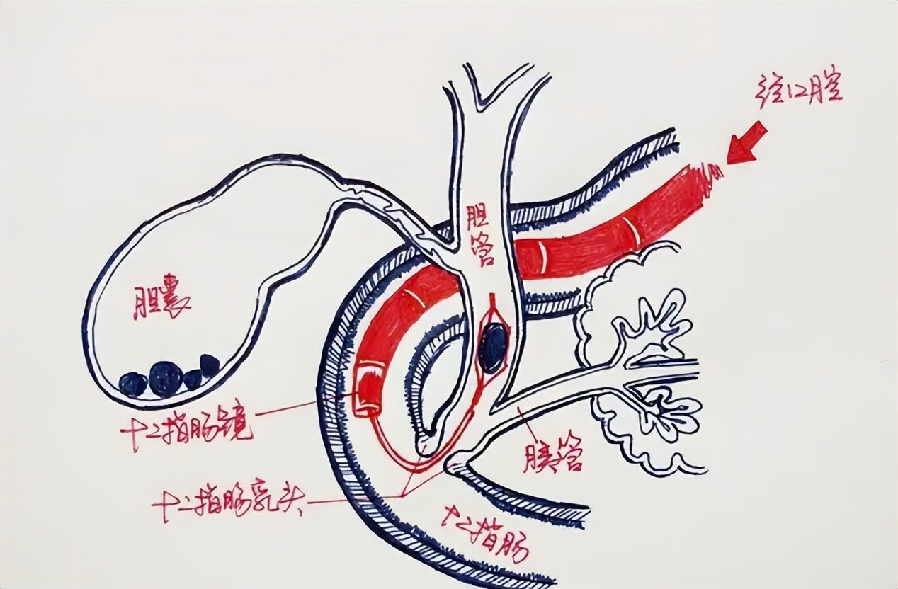 胆囊切除后对人体影响很大,胆囊切除对人体器官影响大吗