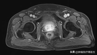 放射治疗前列腺癌费用多少,前列腺癌放射治疗最新指南