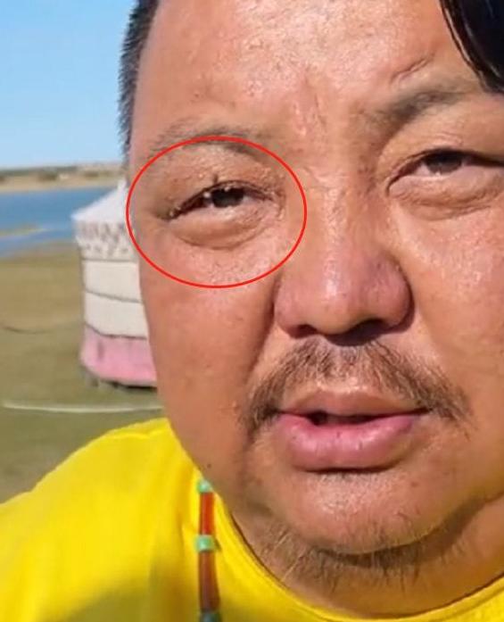 “羊亡爷”恩克:5个月内吃110只羊,从不吃青菜,面色乌青疵扩散